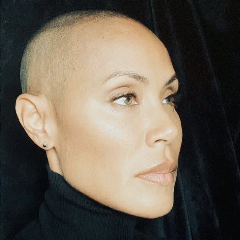 Alopecia areata acomete cerca de 2% dos brasileiros