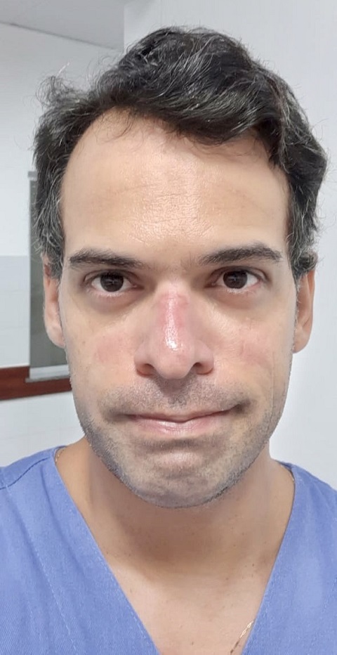 EPIs machucam o rosto dos profissionais de Saúde. Foto: arquivo pessoal